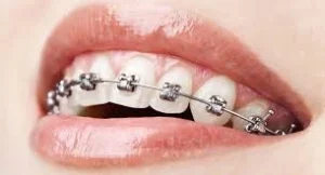 orthodontic braces